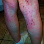 Et alvorligt tilfælde af atopisk dermatitis hos en 14 årig